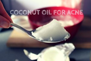 How To Cure Acne Quickly With Coconut Oil?